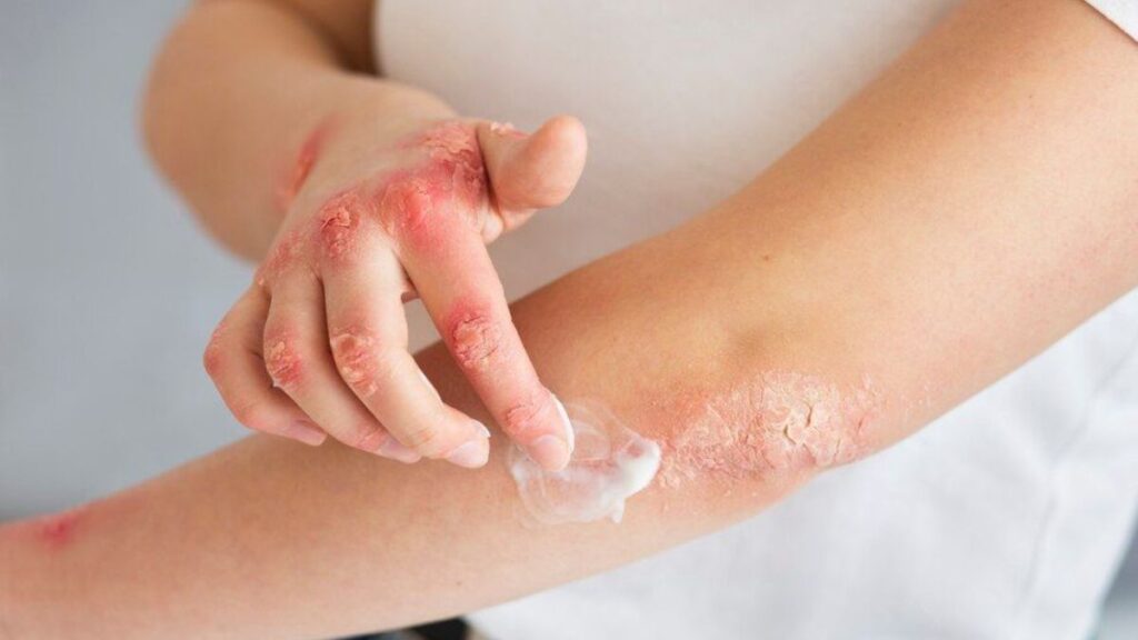 Why Eczema Happens: Common Triggers and Factors